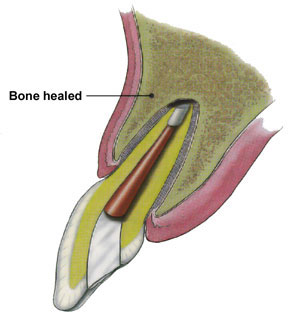 Apicoectomy Endodontics