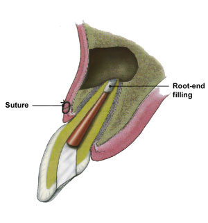 Apicoectomy San Luis Obispo