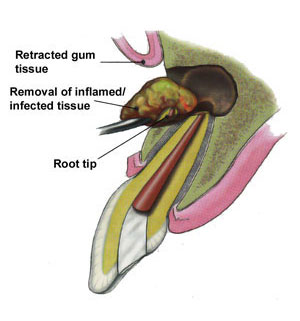 Apicoectomy