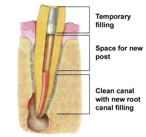 Endodontic Retreatment