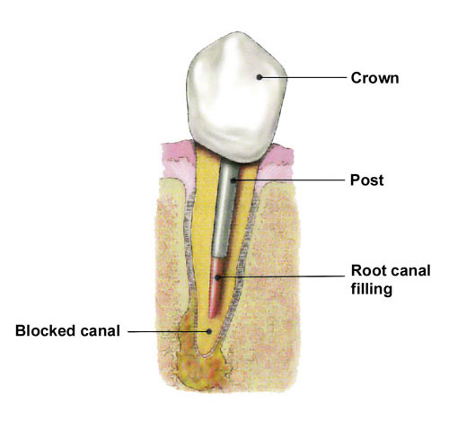 Endodontic Retreatment Therapy