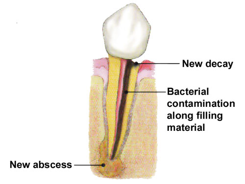 Endodontic Retreatment Procedure