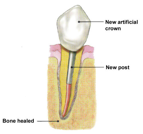 Endodontic Retreatment San Luis Obispo