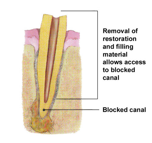 Endodontic Retreatment San Luis Obispo CA