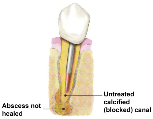 Endodontic Retreatment San Luis Obispo