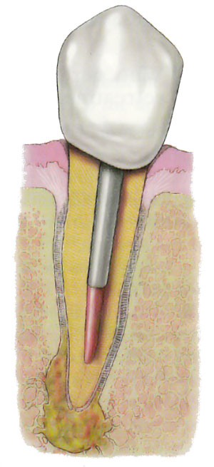 Endodontic Retreatment