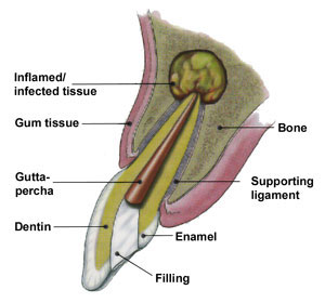 Endodontic Surgery Infection