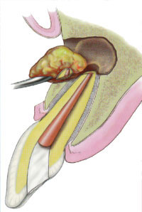 Endodontic Surgery