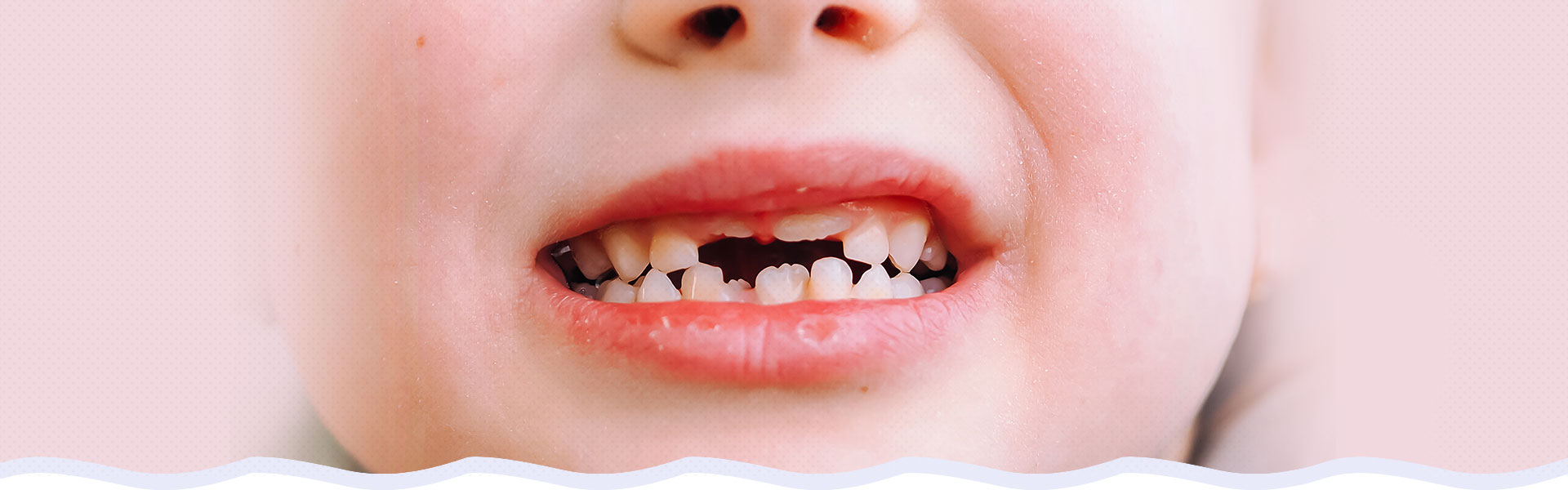 dental injuries in children