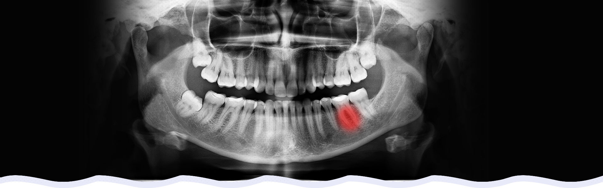 dental Traumatic injury